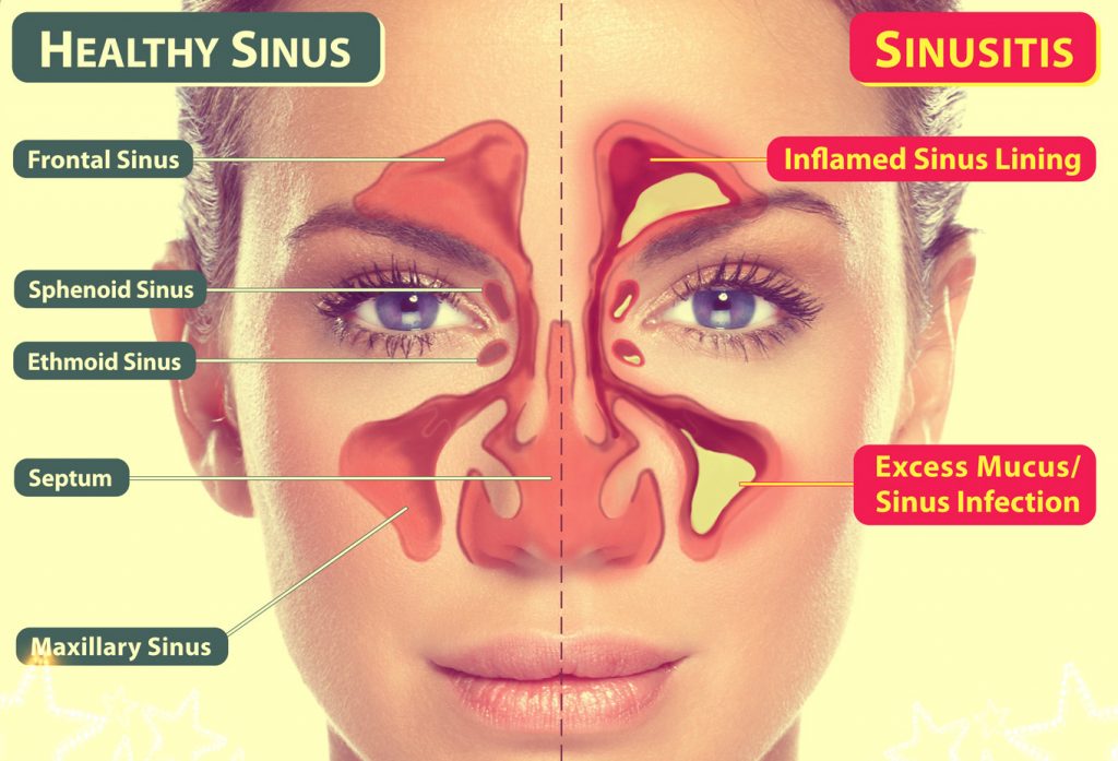 سینوزیت