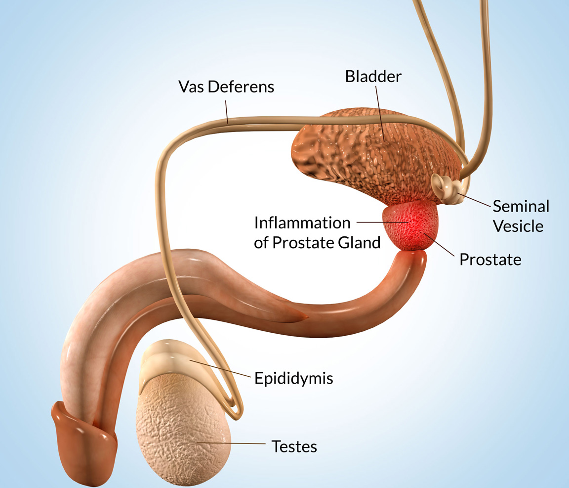 Prostate Disease 