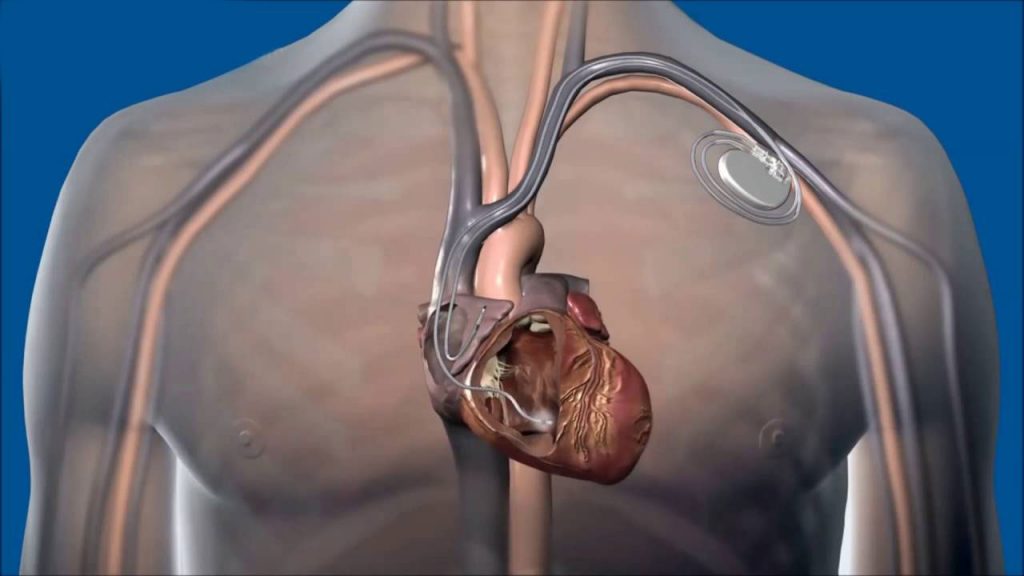 محل قرار گرفتن پیس میکر