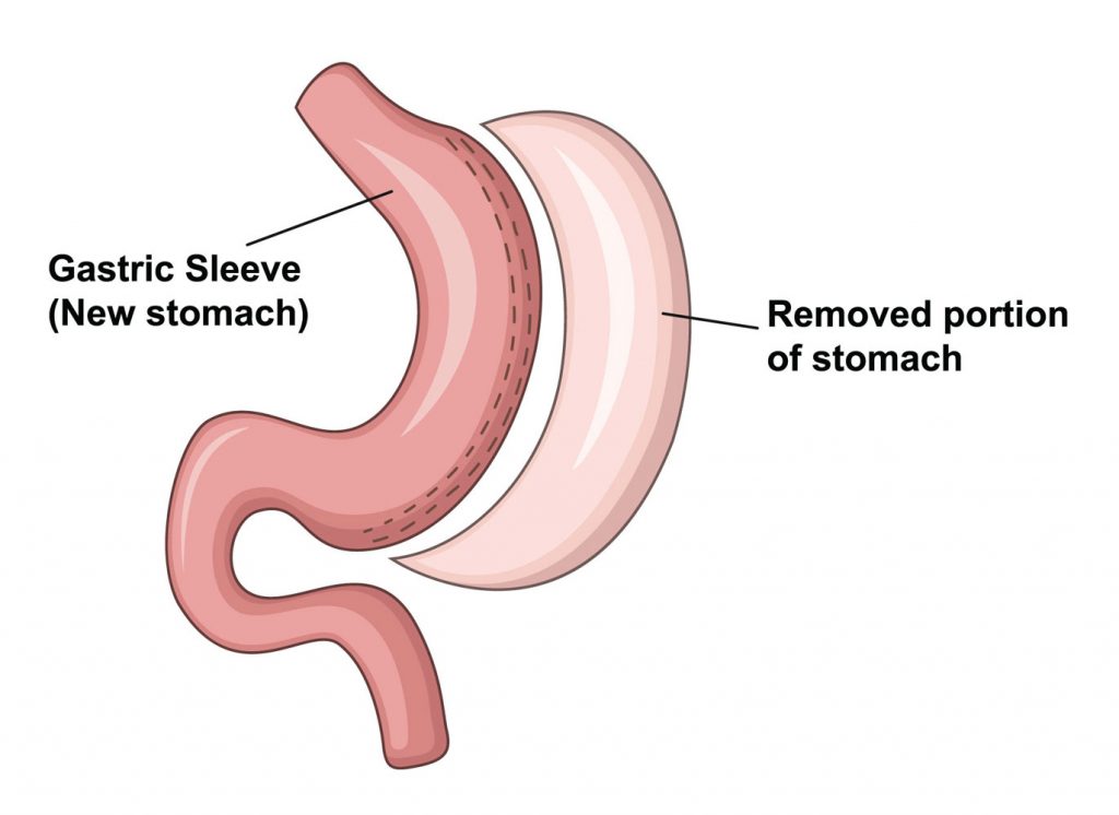 جراحی آستینی یا اسلیو