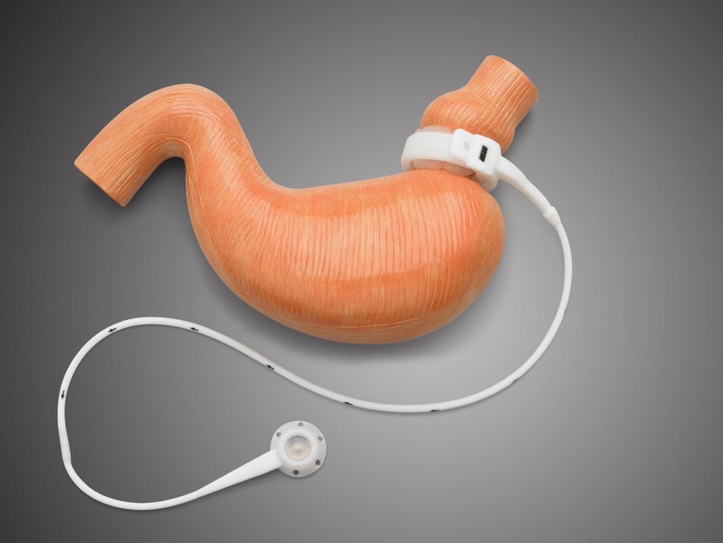 جاگذاری حلقه معده