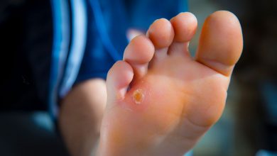 آنچه از میخچه پا باید بدانید