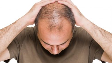 بانک مو برای پیشگیری از طاسی (کچلی) افتتاح شد