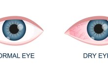 منظور از خشکی چشم چیست؟